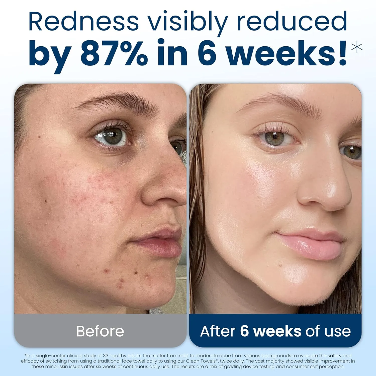 Clean Towels before and after six weeks redness visibly reduced graphic